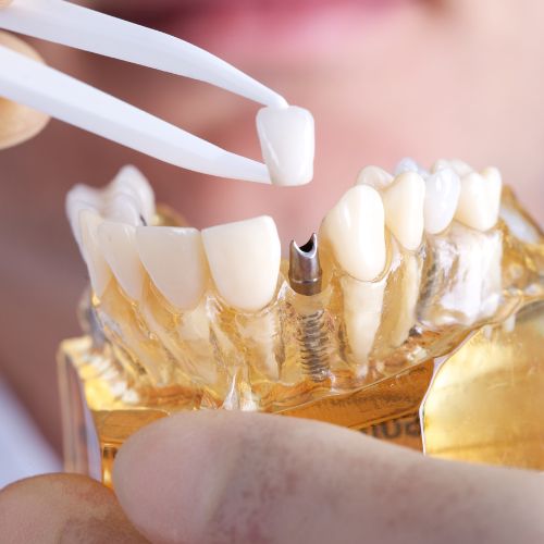 Dental implants in Turkey