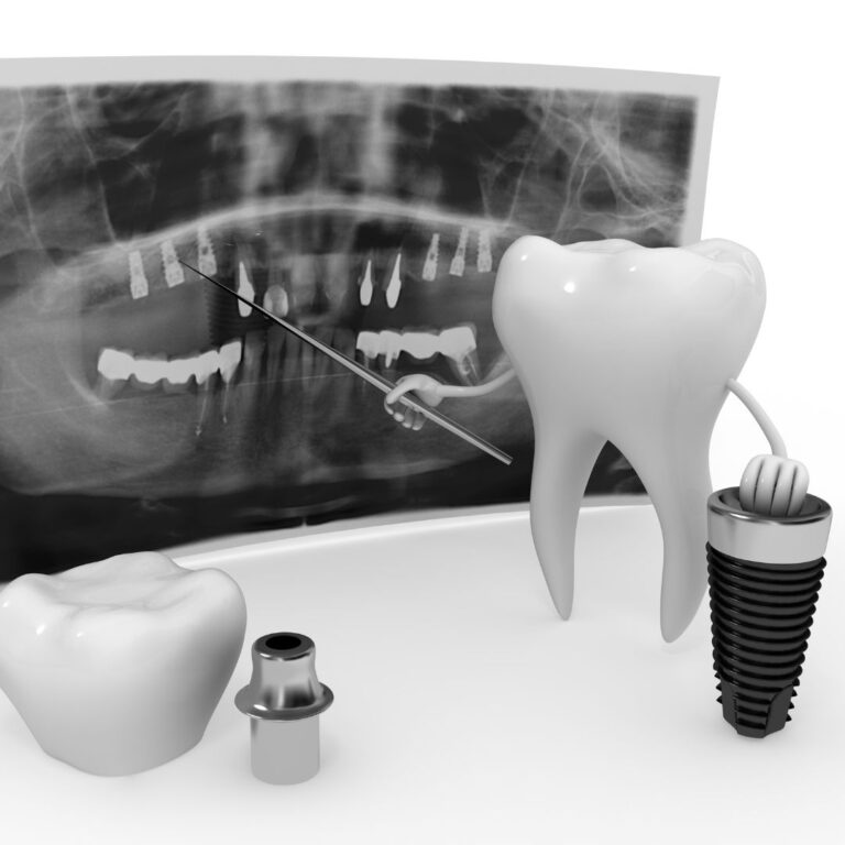 How Long Do The Procedure Of Dental Implants Take In Turkey?