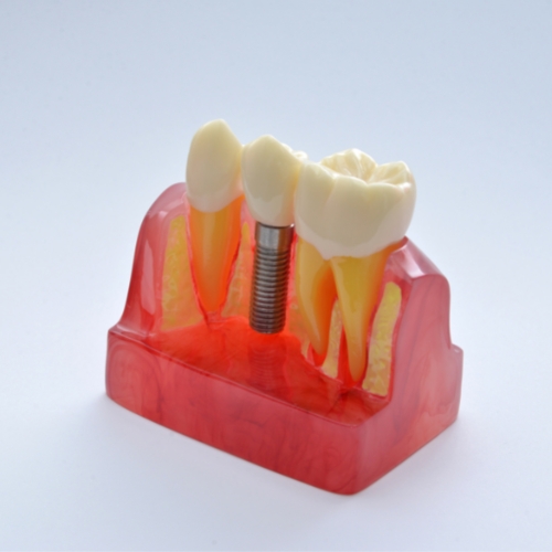 Dental Implants in Fethiye