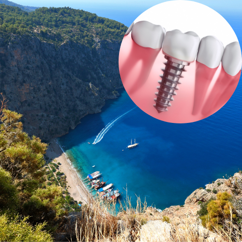 dental implants in fethiye