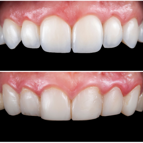 Veneers reviews