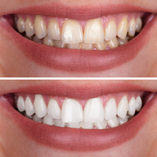 Teeth Whitening in turkey